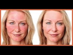 Image result for ‫لیزر برای روزاسه‬‎