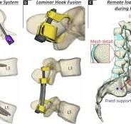 Posterior spinal stabilization: A biomechanical comparison ...