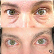 Denver's Eyelid Surgery Specialist