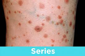 Image result for Coagulation Bleeding Disorder