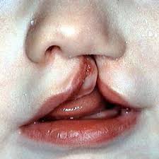 >> on n'attrape pas de lièvre avec un tambour. Bec De Lievre Conseil Dentaire Dr Hauteville