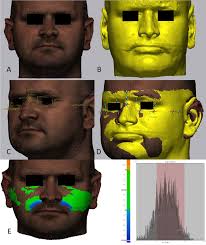 A: Postoperative 3D scan, B: Preoperative simulation of the...