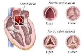 Aortic Stenosis Please Repin Like Follow On Twitter Http Www Twitter Com Noelitoflow Noelitoflow Gezondheid En Fitness Fitness Gezond