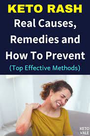 Keto Rash Causes Remedies And How To Prevent Keto Vale Keto Rash Rash Treatment Best Keto Diet