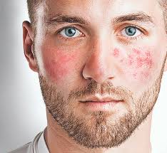 Entzundliche Dermatosen Rosacea Asthetische Dermatologie In Wien Dr Barbara Franz
