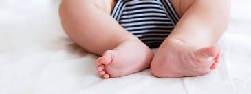 Der sichelfuß ist die häufigste fußfehlstellung beim baby: Klumpfuss Wenn Die Fusse Eures Babys Verdreht Sind Babymarkt De