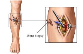 If a bone with a tumor breaks, or fractures, in a leg, it can lead to a pronounced limp. Ewing S Sarcoma Uva Health