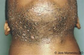 3.7 out of 5 stars 18 ratings. Pseudofolliculitis Barbae American Osteopathic College Of Dermatology Aocd
