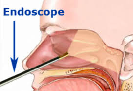 Endoscopic ENT surgery