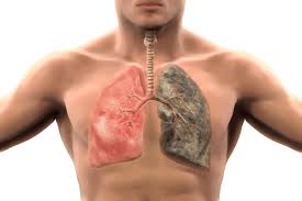 What is the vector of malaria? Lung Cancer Prevalence Causes Symptoms Treatment Prevention Factdr