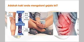 Kondisi ini digambarkan sebagai bag of worm (kantung cacing). Beauty Mirelle St Pant Posty Facebook