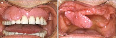 Plexiform fibroma sclerosing fibroma osseous fibroma buccal mucosa cancer buccal mucosa lump buccal mucosa lichen planus buccal mucosa ulcer. Diseases Of The Oral Mucosa And Soft Tissues General Aspects Pocket Dentistry