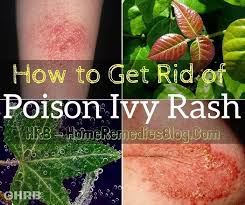 15 Best Home Remedies To Get Rid Of Poison Ivy Rash Poison Ivy Rash Poison Ivy Home Remedies Poison Ivy Treatment