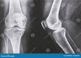 Image result for Knee XRay