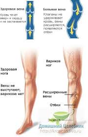 чем лечить варикозное расширение вен на ногах в домашних условиях Varikoznoe Rasshirenie Ven 10 Receptov Lecheniya Bez Tabletok I Operacii Varikoz Zdorove Medicina