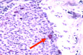 What is bone marrow cancer? Bad To The Bone Some Breast Cancer Cells Are Primed To Thrive Hhmi