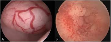 Signs of uterine cancer include unusual bleeding. Hysteroscopic Endometrial Focal Resection Followed By Levonorgestrel Intrauterine Device Insertion As A Fertility Sparing Treatment Of Atypical Endometrial Hyperplasia And Early Endometrial Cancer A Retrospective Study Journal Of Minimally Invasive
