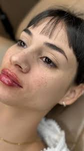 Relleno de labios con ácido hialurónico, la técnica ideal para darles  hidratación y volumen, Te esperamos en calle San Juan 2312, Rosario