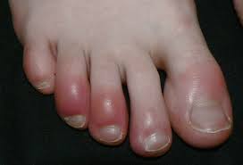 Under lång tid hade jag drömt om att få till en lättskött. Koronaviruset Symptomer Ser Taerne Dine Slik Ut Da Bor Du Teste Deg For Korona