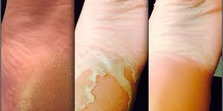Before you start, you may want to remove any nail polish you're wearing, because the acids will destroy the shine and make it look dull. Everyone S Raving About Baby Foot For Calluses But Is It Safe Women S Health