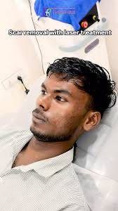 Transforming scars into smoother, healthier skin + # Watch the power of  fractional CO2 laser resurfacing in action! This advanced treatment helps  reduce the appearance of post-traumatic scars, ...