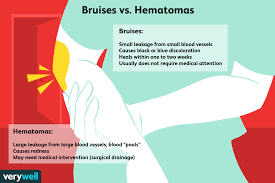 Bruising after blood draw may happen to anyone. What Is The Difference Between Bruises And Hematomas