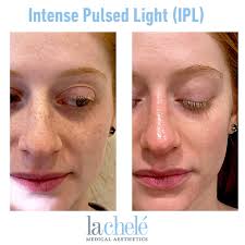 A few strands of hair grow out in between the brazilian ipl sessions and . Ipl Photofacial In Bucks County La Chele Medical Aesthetics