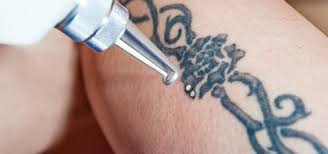 Not only is there pain and a lot of cost after the treatments a lot of times i get blistering and have to be careful about. How Much Does Tattoo Removal Cost Victorian Dermal Group