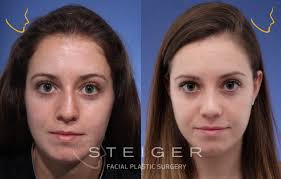 Check spelling or type a new query. Rhinoplasty Before And After Photos