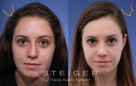 Why do nose jobs go bad? Rhinoplasty Before And After Photos