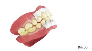 Blanchiment Des Dents Bucco