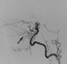 Image result for Epistaxis