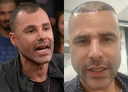 Veja cinco jovens do corinthians que mostraram serviço a sylvinho antes de estreia. Rodrigo Sant Anna Mostra Primeira Fase De Transplante Capilar Video Quem Quem News