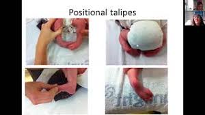 A club foot or clubfoot, also called congenital talipes equinovarus, is a congenital deformity involving one foot or both. Talipes Clubfoot Steps Charity