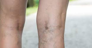 We did not find results for: What Causes Throbbing Veins Before Your Period Clement Banda Md Dermatologist