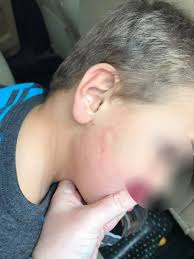 Resultado de imagen para imagenes de niÃ±os con marcas de golpes