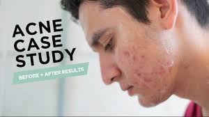 Acne Case Study Before + After Results