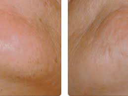 Does waxing reduce hair growth? The Best Facial Epilator Plus Tips On How To Use It Bellatory