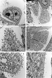 As practical considerations is electron microscopy. Mesothelioma Of The Tunica Vaginalis With Berep4 And Leum1 Expression Identification Of Cytoplasmic Tonofilaments By Electron Microscopy Is A Key Diagnostic Feature Journal Of Clinical Pathology