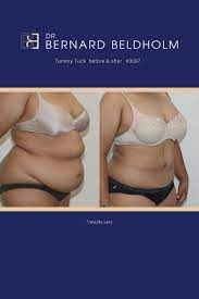 Check spelling or type a new query. Pin On Tummy Tuck Before After