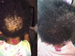 If you have issues with dandruff, minor hair loss, alopecia, dry or damaged hair, or too many grey hairs, read on to learn how to use black seed oil. 3 Ways To Prevent Hair Loss In Kids Voice Of Hair