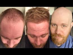 This Guy Completely Reversed Hair Loss But Went Bald Again Here S Why Youtube Hair Loss Bald Going Bald Slow Hair Loss