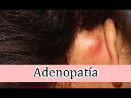 Bultos Detras De Oreja Ganglios Inflamados Adenopatia Youtube