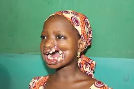 Noma Aid Nigeria Unveils State-of-the-Art Treatment Centre For Sufferers