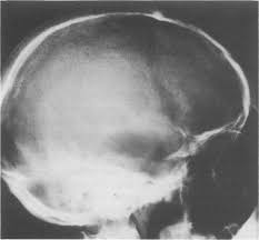 Skull X Ray Lateral View Note Enlargement Of Pituitary Fossa Loss Download Scientific Diagram