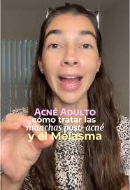 Acné adulto marcas post acne Melasma piel madura 🌞 Versión adaptada p...