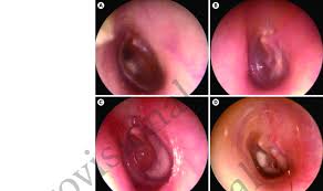 Image result for Myringosclerosis