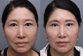 Jun 12, 2020 · if you are considering eyelid surgery or blepharoplasty in nyc, a face or neck lift, fillers or fat injections, botox, dysport, double eyelid surgery, a brow lift, a thread lift, ptosis repair, tear trough fillers or other ways to look younger while maintaining your natural beauty, dr. Subbrow Lift Using Frontalis Sling To Correct Lateral Orbital Laxity Springerlink