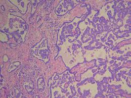 Maybe you would like to learn more about one of these? The Most Frequent Type Is Epithelioid Malignant Mesothelioma Download Scientific Diagram