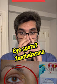Understanding Xanthelasma: What are Eye Spots?